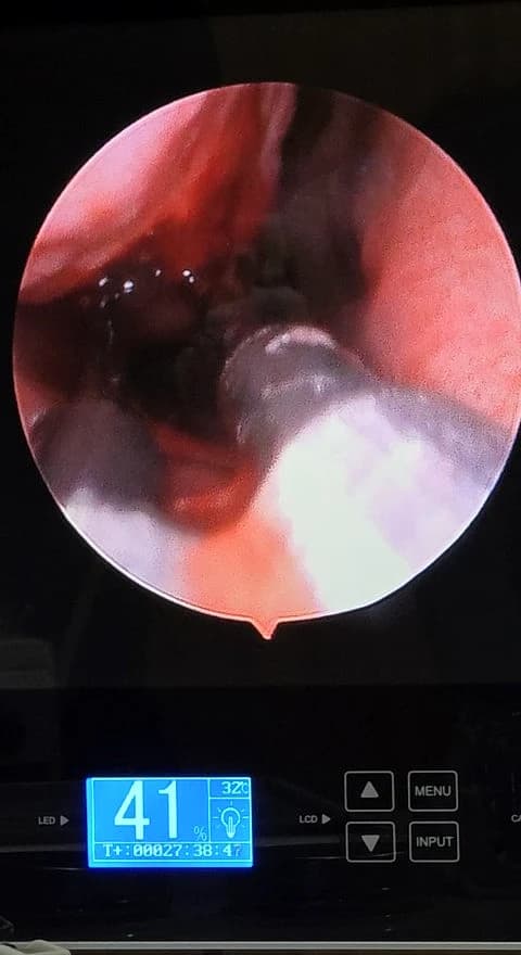 ENT specialist performing radiofrequency turbinate reduction (RF Turbinoplasty) to treat chronic nasal obstruction at RAJVITHI CLINIC.