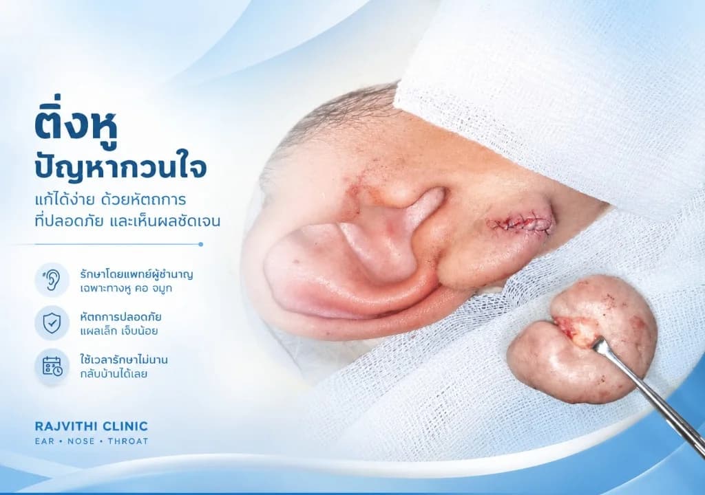 ผ่าตัดคีลอยด์ใบหูโดยแพทย์เฉพาะทางหู คอ จมูก พร้อมเย็บแผลอย่างประณีต ที่ราชวิถีคลินิก หู คอ จมูก เชียงใหม่